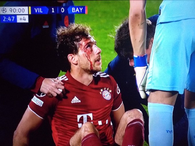 ¡No puedo soportar ver! El centrocampista del Bayern Munich está cubierto de sangre después de un codo